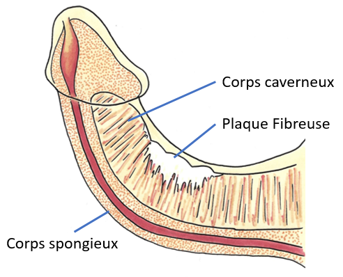 conséquences maladie de Lapeyronie